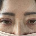二重埋没 ルラ美容クリニック 郡山院 BEFORE サムネイル用