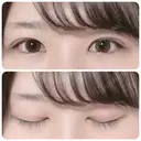 二重切開 / 上まぶたの脂肪取り 太田西ノ内病院 BEFORE サムネイル用