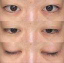 眼瞼下垂（切開） / その他（目元） / 目尻切開 / 自然癒着法 POP美容整形クリニック BEFORE サムネイル用