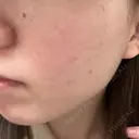 ルメッカ ルラ美容クリニック 名古屋栄院 / ルラスキンクリニック 名古屋栄院 BEFORE サムネイル用