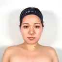 糸リフト / バッカルファット除去 / 脂肪吸引（顔） / ボトックス（口角） / ボトックス（首） アリエル美容クリニック 水戸院 BEFORE サムネイル用