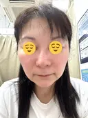 エレクトロポレーション 湘南美容クリニック 松戸院 BEFORE サムネイル用