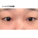 二重埋没 湘南美容クリニック 福島院 BEFORE サムネイル用