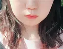 糸リフト / ヒアルロン酸注入（あご） / 脂肪溶解注射（顔） リエンジャン整形外科 江南店 BEFORE サムネイル用