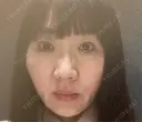 糸リフト / クマ治療 / バッカルファット除去 / ボトックス（エラ・小顔） / スネコス 札幌美容外科ネビュラクリニック BEFORE サムネイル用