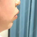 ボトックス（あご） / ヒアルロン酸注入（あご） HAAB CLINIC 福岡院 BEFORE サムネイル用