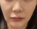 RF（高周波）たるみ治療 WITH BEAUTY CLINIC BEFORE サムネイル用