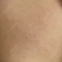 医療脱毛（背中） 湘南美容クリニック 岡山院 BEFORE サムネイル用