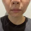 脂肪溶解注射（顔） / ハイフ（顔） HINATA クリニック BEFORE サムネイル用