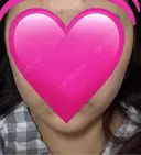 インモード ARTE BEAUTY CLINIC BEFORE サムネイル用