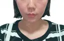 ピーリング（ニキビ・毛穴） / 毛穴洗浄（ハイドラフェイシャルなど） / LDM・インテンスウルトラ AB美容クリニック 新宿院 BEFORE サムネイル用