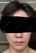糸リフト / 脂肪吸引（顔） / ジョールファット除去 アリエル美容クリニック 郡山院 BEFORE サムネイル用