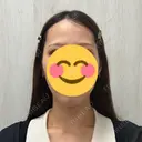 ヒアルロン酸注入（頬） ライブリークリニック 船橋院 BEFORE サムネイル用