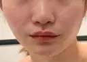 糸リフト / 脂肪吸引（顔） / ボトックス（エラ・小顔） First Clinic BEFORE サムネイル用