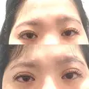 二重埋没 HAAB×DREAM BEAUTY CLINIC 大阪梅田院 BEFORE サムネイル用