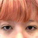 二重埋没 共立美容外科 立川院 BEFORE サムネイル用