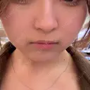 ヒアルロン酸注入（あご） DMTC CLINIC 渋谷院 BEFORE サムネイル用