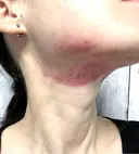 ルメッカ / インモード Moon Beauty Clinic BEFORE サムネイル用