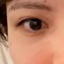 二重埋没 水の森美容クリニック 横浜院 BEFORE サムネイル用
