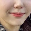ヒアルロン酸注入（涙袋） / ヒアルロン酸注入（鼻翼基部） ルラ美容クリニック 渋谷本院 BEFORE サムネイル用