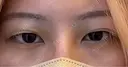 二重切開 / 眼瞼下垂（切開） eクリニック 大阪院 BEFORE サムネイル用