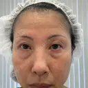 クマ治療 NARU Beauty Clinic 【ナルクリ】 BEFORE サムネイル用