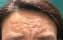 ボトックス（眉間） / ボトックス（額） HAAB×DREAM BEAUTY CLINIC 大阪梅田院 BEFORE サムネイル用