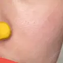 肌育注射（ジュベルックなど） / イオン導入 / 光治療（フォトフェイシャルなど） / ルメッカ Belle Via Clinic BEFORE サムネイル用