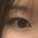 ヒアルロン酸注入（涙袋） the way（ザウェイ）整形外科 BEFORE サムネイル用