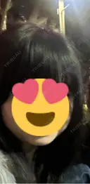 脂肪吸引（顔） R Beauty CLINIC 銀座院 BEFORE サムネイル用