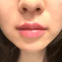 ヒアルロン酸注入（唇） PRO CLINIC プロクリニック 銀座院 BEFORE サムネイル用
