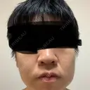 糸リフト / バッカルファット除去 / 脂肪吸引（顔） / ジョールファット除去 / 脂肪吸引注射（顔） SEA CLINIC（シークリニック） BEFORE サムネイル用