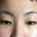 二重埋没 / 目頭切開 / 上まぶたの脂肪取り 湘南美容クリニック 京都院 BEFORE サムネイル用