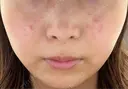 その他（輪郭） / 医療痩身（顔） / その他（肌） / RF（高周波）たるみ治療 / オンダリフト ライブリークリニック 船橋院 BEFORE サムネイル用