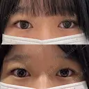 ヒアルロン酸注入（涙袋） / ボトックス（あご） / ボトックス（エラ・小顔） フィラークリニック 名古屋栄院 BEFORE サムネイル用