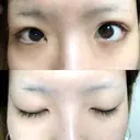 二重切開 / 上まぶたの脂肪取り TCB東京中央美容外科 江坂院 BEFORE サムネイル用