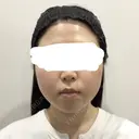糸リフト / バッカルファット除去 / 脂肪吸引（顔） / ネックリフト / ヒアルロン酸注入（あご） / ボトックス（エラ・小顔） / ヒアルロン酸注入（唇） / ヒアルロン酸注入（鼻翼基部） / ヒアルロン酸注入（ほうれい線） HAAB×DREAM BEAUTY CLINIC 東京本院 BEFORE サムネイル用
