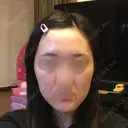 骨切り（あご） / 骨削り（エラ） / 骨削り（頬） RG整形外科（旧リオン整形外科） BEFORE サムネイル用