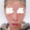 骨切り（あご） / 骨削り（頬） / ガミースマイル手術 / ルフォー+ssro（両あご) ウォンジン（Wonjin）整形外科 BEFORE サムネイル用