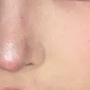 ピーリング（ニキビ・毛穴） HAAB CLINIC 池袋院 BEFORE サムネイル用