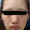 肌育注射（ジュベルックなど） Natural Skin Clinic 自由ヶ丘院 BEFORE サムネイル用