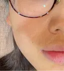 水光注射（ハリ・美肌） メディアージュクリニック 大阪梅田院 BEFORE サムネイル用