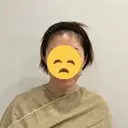 切開リフト GRACY TOKYO CLINIC【グレイシートウキョウクリニック】 BEFORE サムネイル用