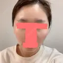 糸リフト / 骨切り（あご） / 骨削り（エラ） / 骨削り（頬） / 脂肪吸引（顔） RG整形外科（旧リオン整形外科） BEFORE サムネイル用