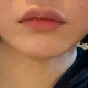 ヒアルロン酸注入（あご） / ヒアルロン酸注入（唇） 麻布十番クレールデンタルクリニック BEFORE サムネイル用