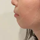 ヒアルロン酸注入（あご） たにまちクリニック BEFORE サムネイル用
