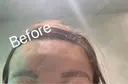 前額リフト / ボトックス（額） WOM CLINIC GINZA （ワム クリニック ギンザ） BEFORE サムネイル用