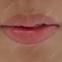 ヒアルロン酸注入（唇） 麻布十番クレールデンタルクリニック BEFORE サムネイル用