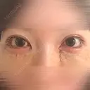 その他（目元） / クマ治療 WOM CLINIC GINZA （ワム クリニック ギンザ） BEFORE サムネイル用