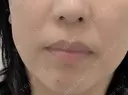 ヒアルロン酸注入（鼻翼基部） DMTC CLINIC 日本橋院 BEFORE サムネイル用